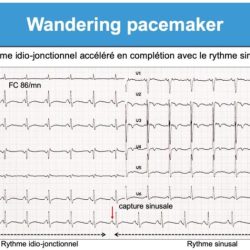 Wandering pacemaker wander ekg phimaimedicine ecg ไม เต เพ แน นอน